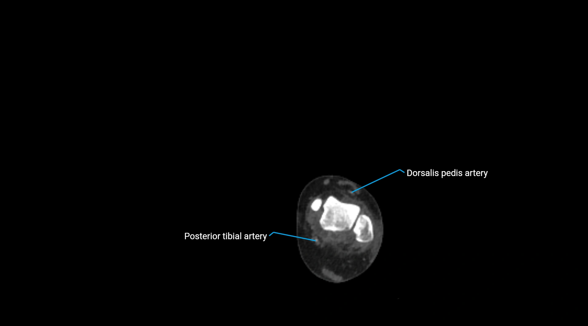 CTA lower limb cross sectional anatomy labelled image _274.webp